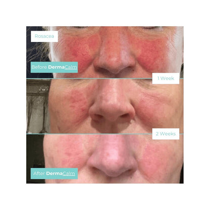 Dermacalm Rescue Mist  (Various Sizes )